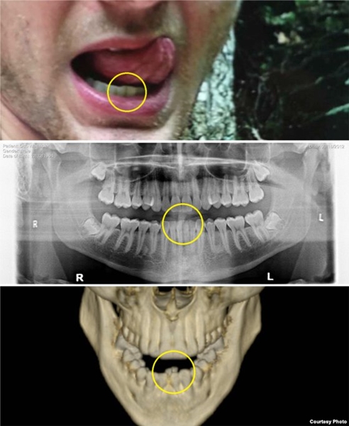 北朝鮮に抑留される前のワームビア氏の口元の写真（上）と歯科エックス線写真（中）を北朝鮮から解放され死亡した後に撮影した頭蓋骨のスキャン写真（下）と比較すると北朝鮮に抑留された間に中央下部の歯が外部からの力と疑われる原因により変形したのを確認できる。（写真＝ＶＯＡ）