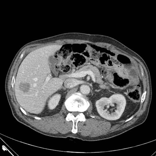 若くして発生する早期発病胃がんはびまん性が多く、診断が難しく広範囲に広がっているのが特徴だ。胃がんが肝臓に転移した７０代患者のコンピュータ断層撮影の様子。（写真提供＝ソウル大学校病院）