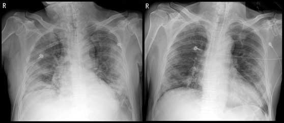 セブランス病院が血しょう治療を行い、完治した患者（キムさん）の肺の写真。キムさんが血しょう治療を受ける前（左）と後（右）の胸部Ｘ線映像。血しょう治療後、肺炎などで白くぼやけて見えた肺が良くなっている。［写真　セブランス病院］