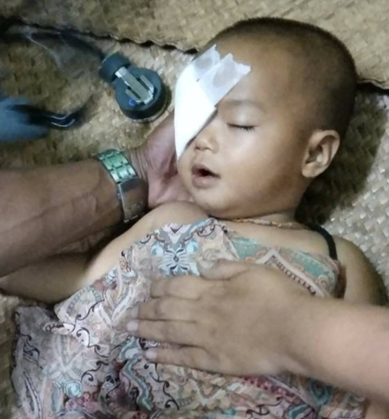 ２７日にヤンゴン近郊で軍警のゴム弾を目に受けガーゼを貼った１歳の女児。［写真　ミャンマーナウツイッター］