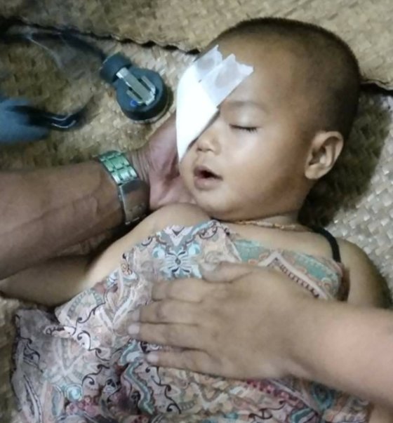 ３月２７日にヤンゴン近郊で軍警のゴム弾を目に受けガーゼを貼った１歳の女児。［写真　ミャンマーナウツイッター］