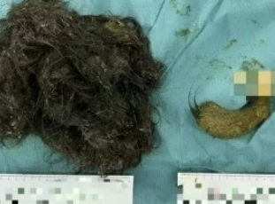 中国陝西省に住む１４歳の少女の腹の中に入っていた髪の毛のかたまり　［バイドゥ　キャプチャー］