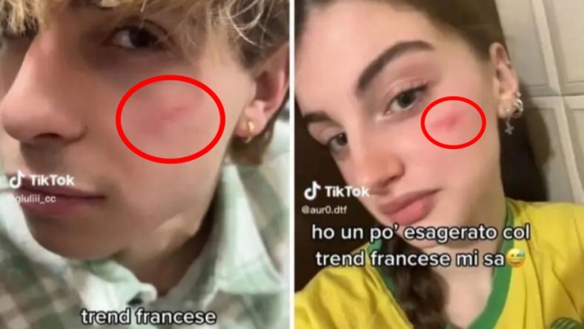 イタリアの１０代の間で流行っている「フレンチ・スカー」チャレンジ［ＴｉｋＴｏｋ　キャプチャー、聯合ニュース］