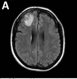 ６０代のオーストラリア人女性の頭の中から寄生虫が発見された。［米国疾病管理予防センター（ＣＤＣ）ホームページ　キャプチャー］