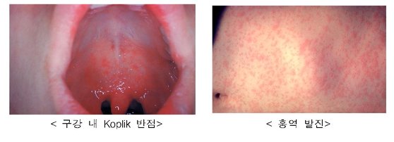 麻疹患者に特徴的に現れる口腔粘膜発疹（左）と皮膚発疹。［写真　米国疾病管理本部］