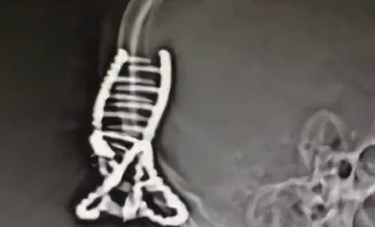 ヘアクリップをしていて負傷した患者のレントゲン写真。［写真　中国極目新聞］