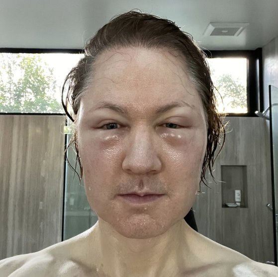   パンパンに腫れたジョンソン氏の顔［写真　ブライアン・ジョンソン氏のインスタグラム　キャプチャー］