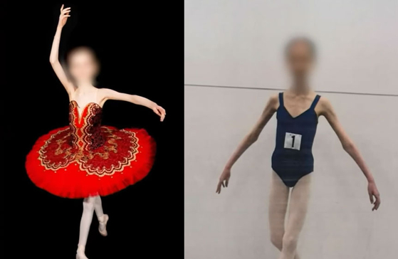 菜食によって慢性栄養失調にかかった１７歳の少女。［オーストラリア「ナインニュース」ユーチューブ（ＹｏｕＴｕｂｅ）　キャプチャー］