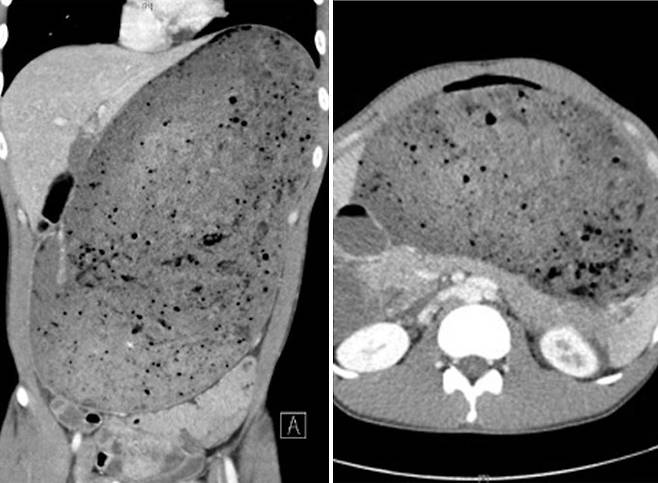 ハンバーガー３．２キロを早食いで完食した男性の腹部ＣＴ［写真　米国胃腸病学ジャーナル（ＡＧＡ）ホームページ］