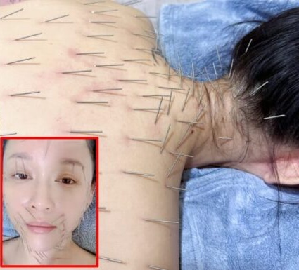 全身に１００本以上の鍼を打っている陳喬恩。［写真　ＳＮＳ］