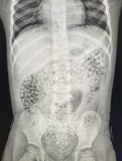   米国でウォータービーズを飲み込んで死亡した１０カ月の子どものレントゲン写真。［写真　米消費者製品安全委員会（ＣＰＳＣ）］
