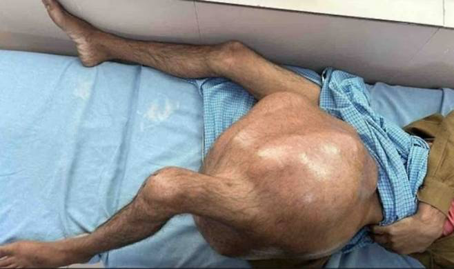 インドのある男性の太ももに育っていた３５キロの腫瘍。［写真　ＳＮＳ］  ​