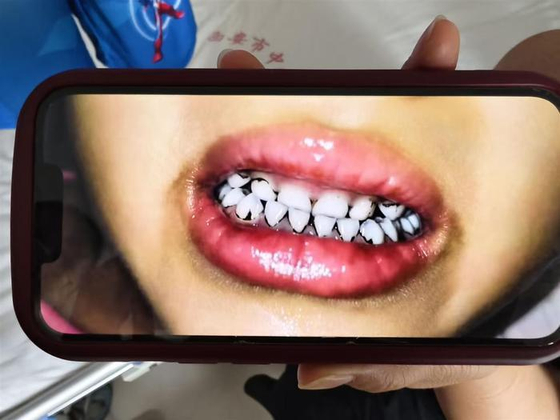 中国で鉛中毒の疑いで歯の一部が黒く変色した園児。［写真　聯合ニュース］