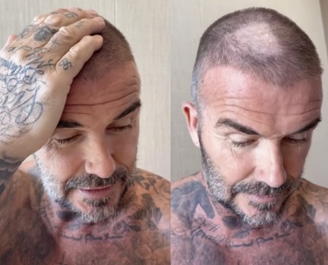 セルフ刈り上げの失敗でハゲたヘアスタイルになったベッカム。［写真　ＳＮＳ］  ​