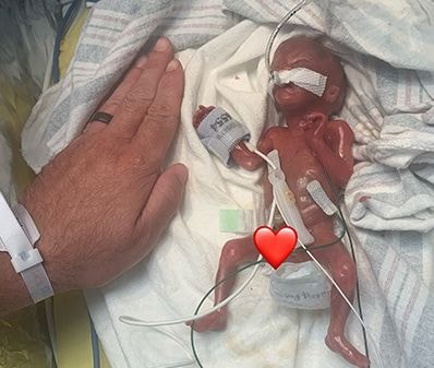 ２８５グラムで誕生したネイシュ・キーンくん。。［写真　ギネス世界記録公式サイト］