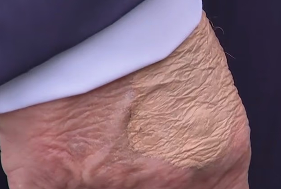 先月１６日（現地時間）、英紙デイリーメールが公開したドナルド・トランプ米大統領の手の甲に見られる化粧の跡。［デイリーメール　キャプチャー］