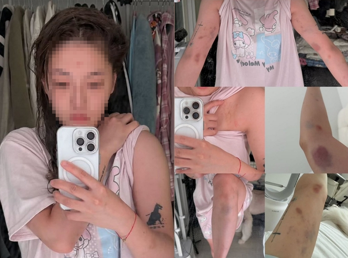   弘大で暴行を受けた台湾人女性のあざ ［写真 劉力穎さんのsns］