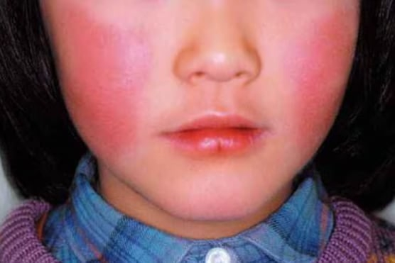   「リンゴ病」で頬に赤い発疹が現れた様子／写真＝沖縄テレビキャプチャー