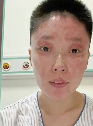 事故で顔にやけどを負った20代の中国人モデル。［写真＝SNS］