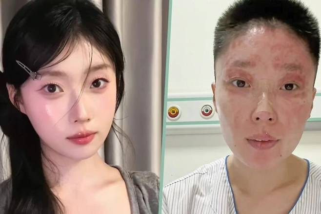  事故で顔にやけどを負った20代中国人モデルの事故前後の姿。［写真＝SNS］