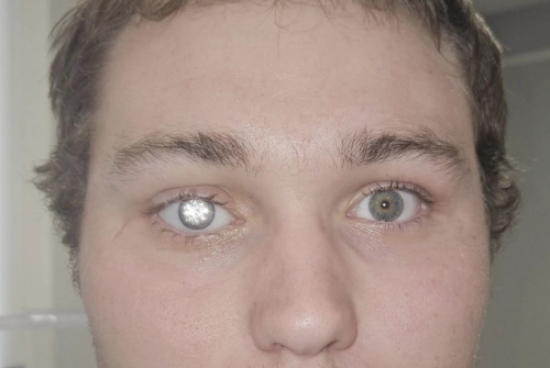   2カラットのダイヤモンドで義眼を作った米国男性。［写真 SNS］