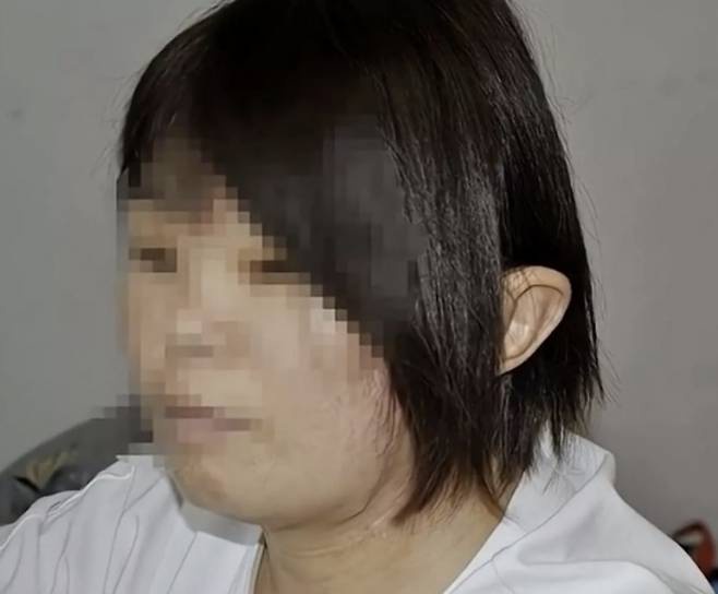 中国で、事故によってちぎれた耳を足の甲に5カ月間にわたって仮移植した女性の話が伝えられた。［写真 SNS］