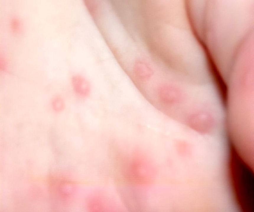台湾で乳幼児の手足口病や新生児敗血症など、さまざまな合併症を引き起こすエンテロウイルス（腸内ウイルス）が拡大している。［写真　疾病管理庁］