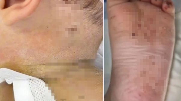 母親の虐待で体に数百個の針跡が残る赤ちゃん ［SCMP キャプチャー］