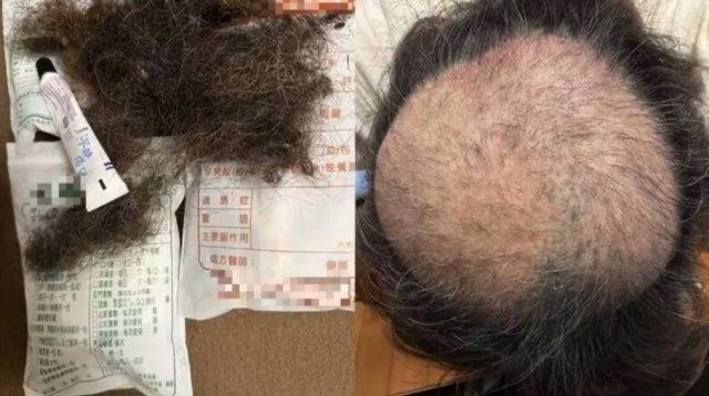 臭豆腐の悪臭による脱毛を主張する男性の頭 ［写真 sns］