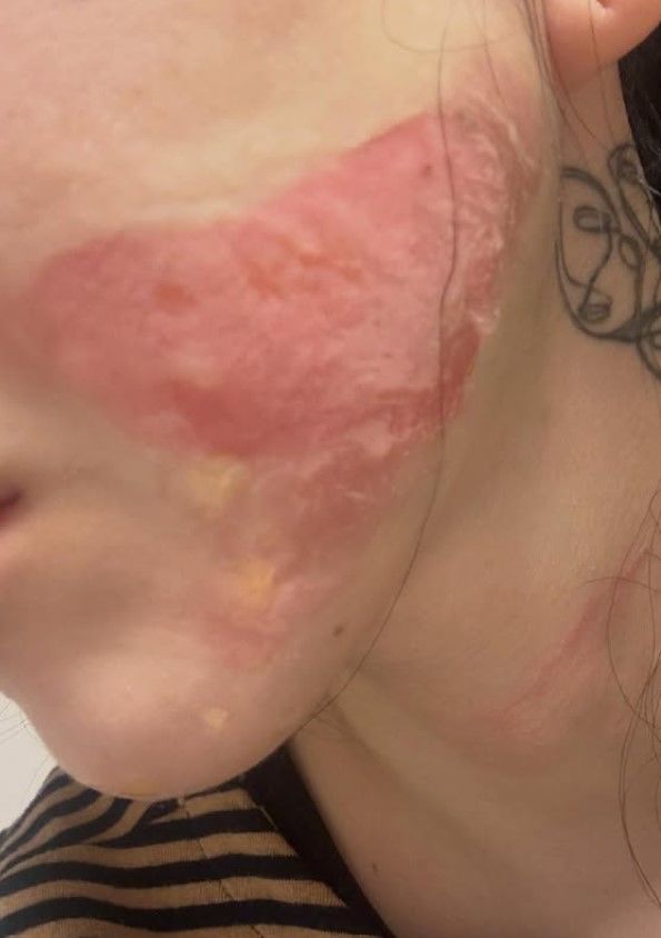   皮膚科施術の副作用で、クォン・ミナの顔面にやけどの痕が残った様子（写真 SNS）