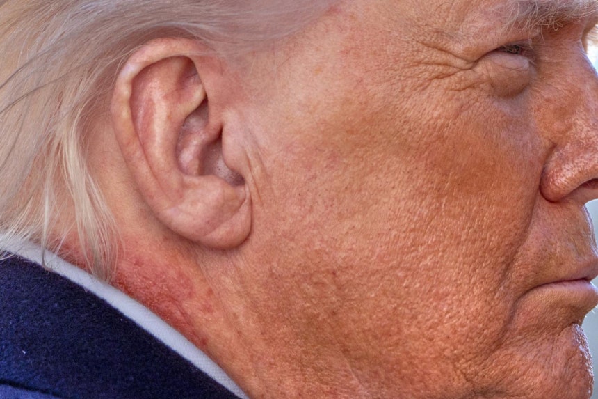   トランプ大統領の首に見える赤い斑点 ［写真 AP］