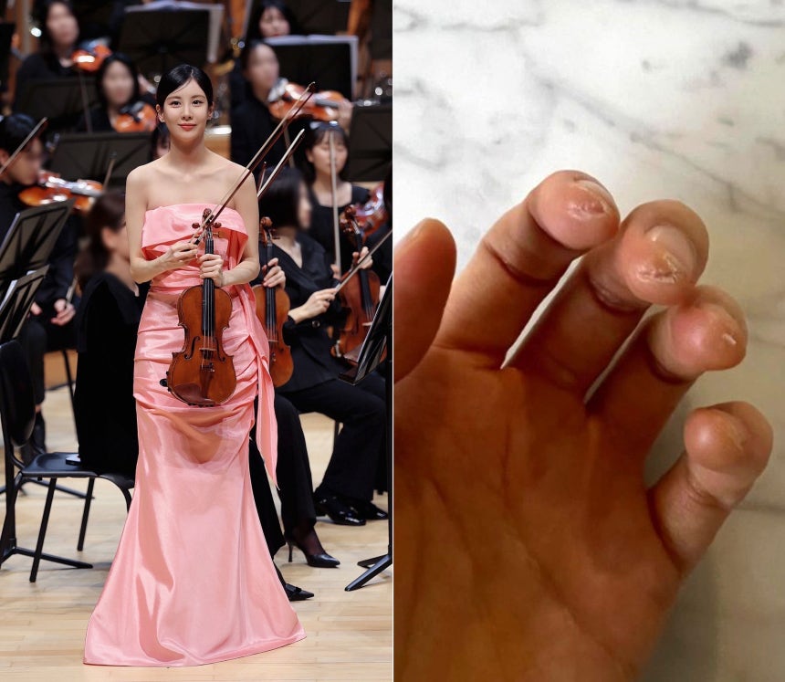グループ少女時代のメンバーで女優のソヒョンが13日、舞台に上がった様子（左）。右の写真は練習のためにささくれだったソヨンの手の指。［写真 所属事務所・インスタグラム キャプチャー］