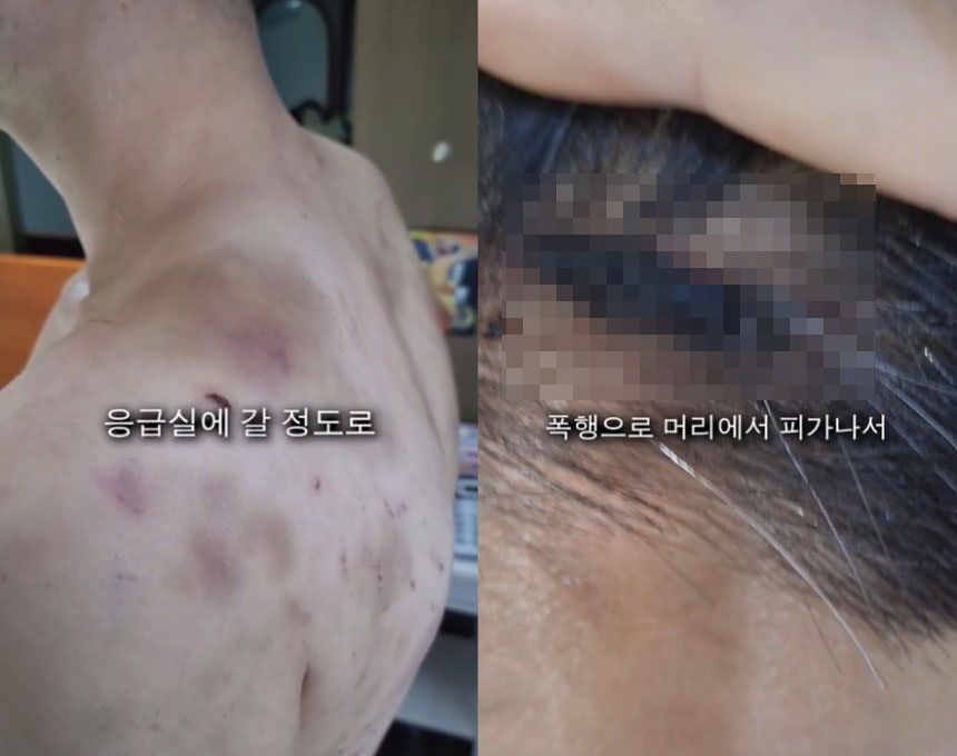  被害者の体に無数のあざがある様子。［写真 SNS キャプチャー］