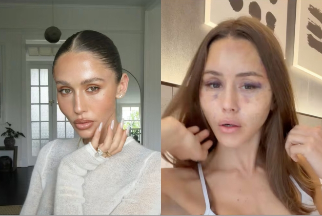   フェイスリフト手術前の姿（左）と、手術後の腫れやあざが残るルビー・チューズデー・マシューズさん。［SNS キャプチャー］