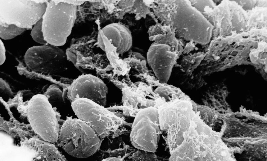 高熱や呼吸困難の症状が現れ、ペストの中でも致死率が最も高い肺ペスト（pneumonic plague）。［AP＝聯合ニュース］